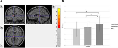 Relationship Between White Matter Integrity and Plasma Leptin Levels in Drug-Naïve and Medicated Patients With Major Depressive Disorder